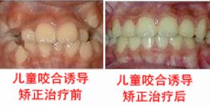 儿童地包天的治疗方法有哪几种